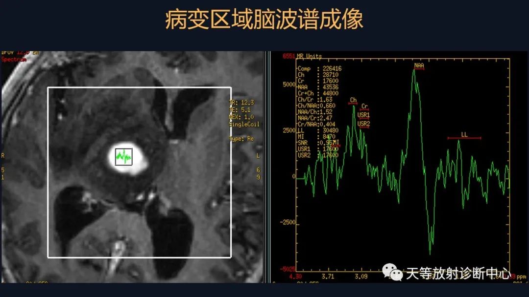 影像PPT - 【病例】脑内淋巴瘤1例MR影像分析-35 影像PPT - 【病例】脑内淋巴瘤1例MR影像分析-35