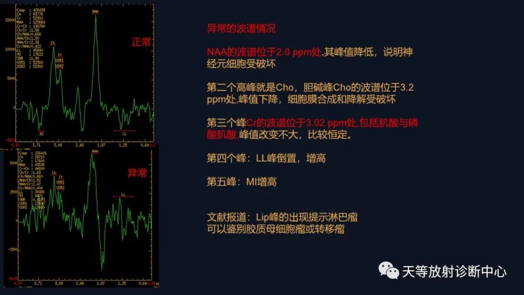 影像PPT - 【病例】脑内淋巴瘤1例MR影像分析-36 影像PPT - 【病例】脑内淋巴瘤1例MR影像分析-36