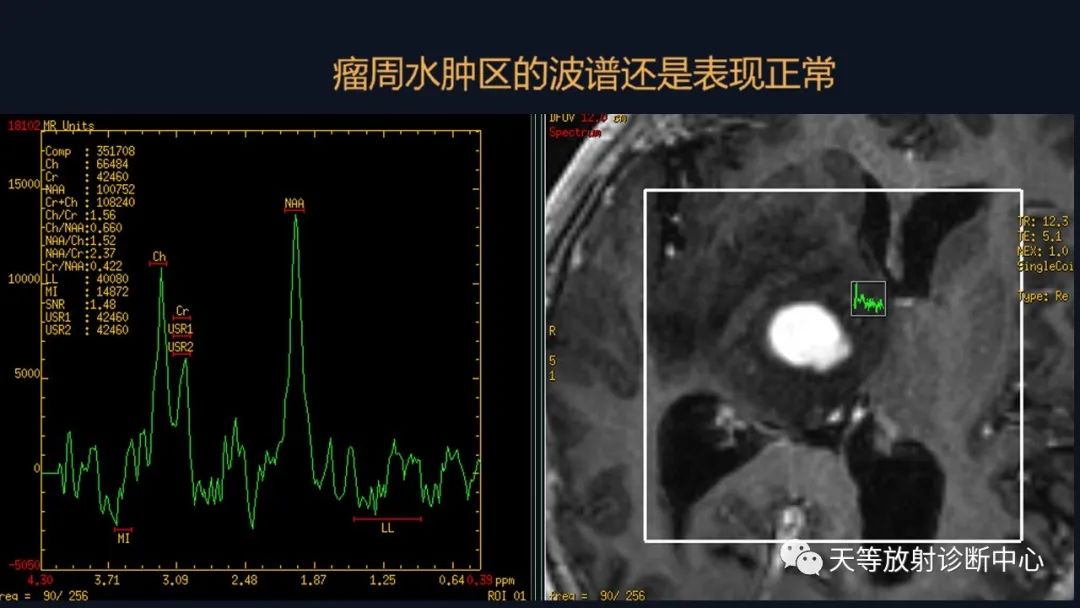 影像PPT - 【病例】脑内淋巴瘤1例MR影像分析-37 影像PPT - 【病例】脑内淋巴瘤1例MR影像分析-37