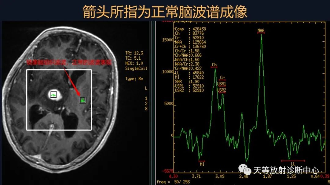 影像PPT - 【病例】脑内淋巴瘤1例MR影像分析-32 影像PPT - 【病例】脑内淋巴瘤1例MR影像分析-32