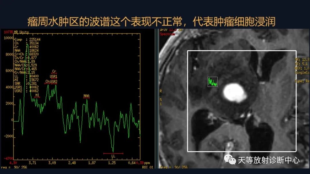 影像PPT - 【病例】脑内淋巴瘤1例MR影像分析-38 影像PPT - 【病例】脑内淋巴瘤1例MR影像分析-38