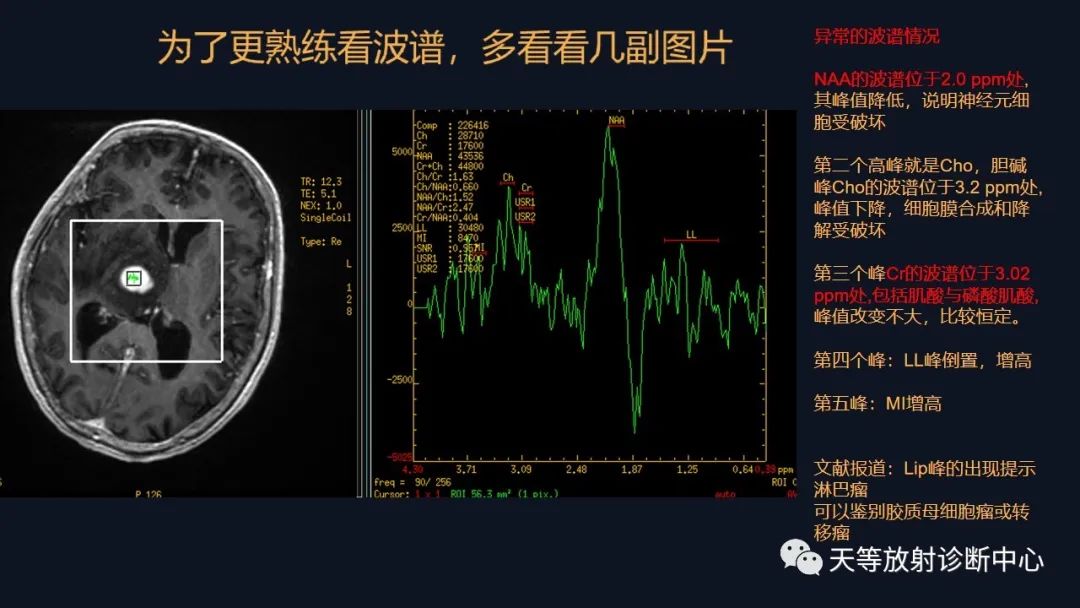影像PPT - 【病例】脑内淋巴瘤1例MR影像分析-41 影像PPT - 【病例】脑内淋巴瘤1例MR影像分析-41