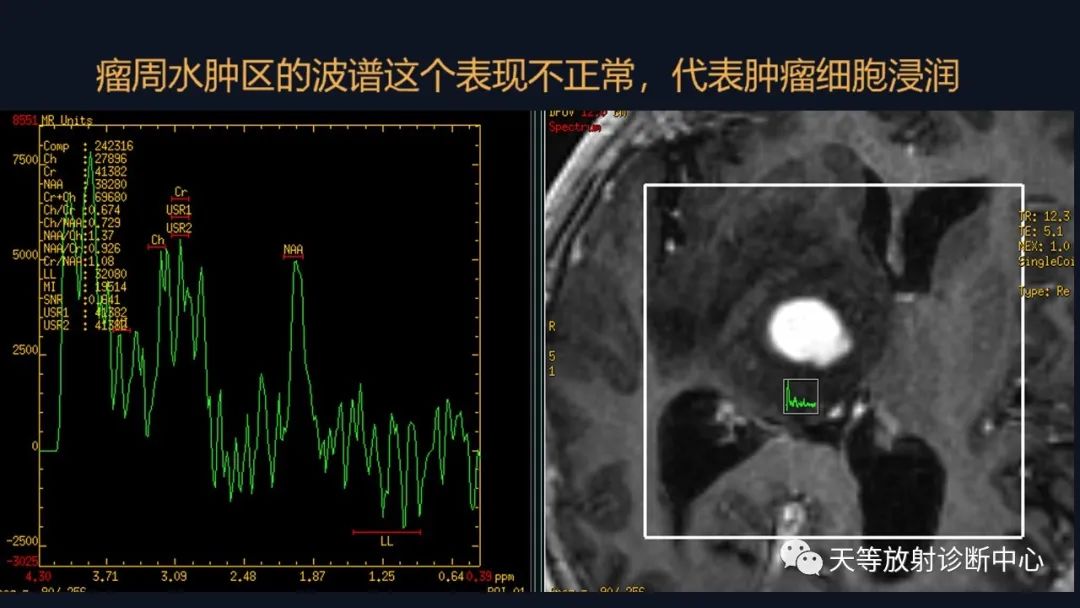 影像PPT - 【病例】脑内淋巴瘤1例MR影像分析-39 影像PPT - 【病例】脑内淋巴瘤1例MR影像分析-39