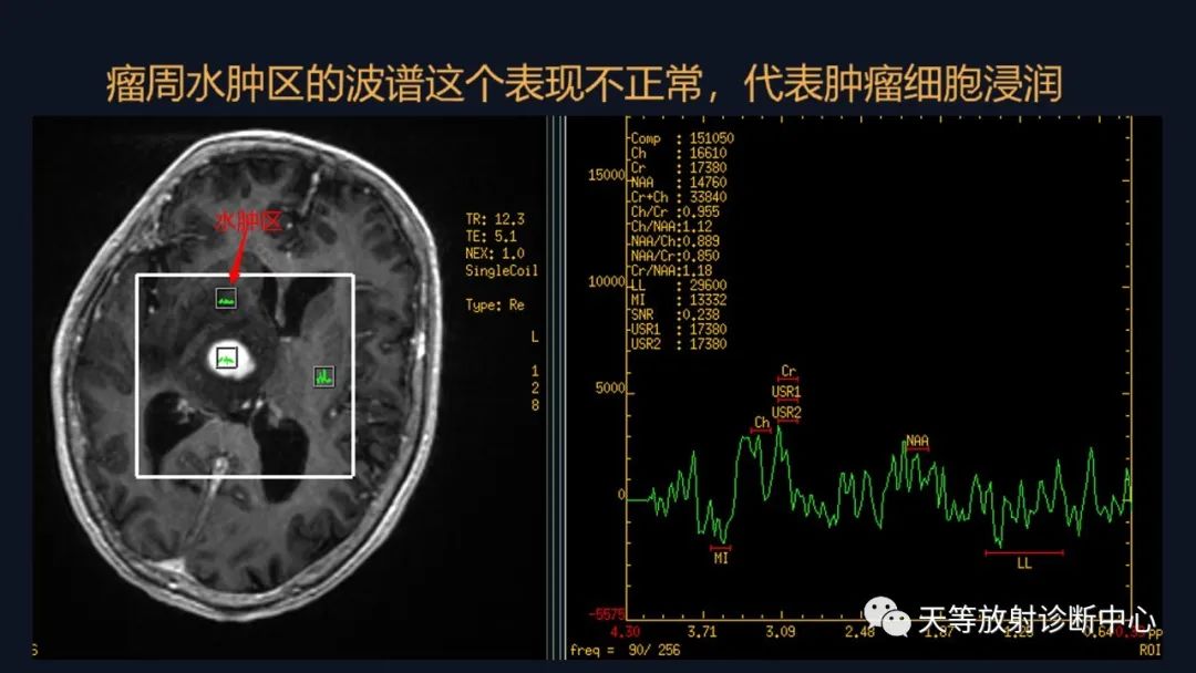 影像PPT - 【病例】脑内淋巴瘤1例MR影像分析-43 影像PPT - 【病例】脑内淋巴瘤1例MR影像分析-43
