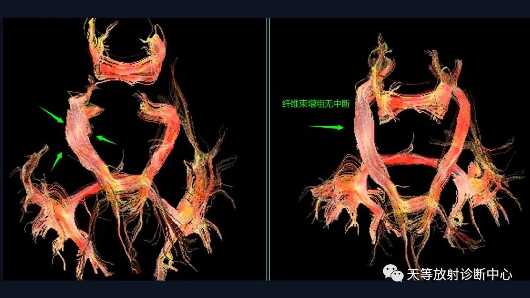 影像PPT - 【病例】脑内淋巴瘤1例MR影像分析-50 影像PPT - 【病例】脑内淋巴瘤1例MR影像分析-50
