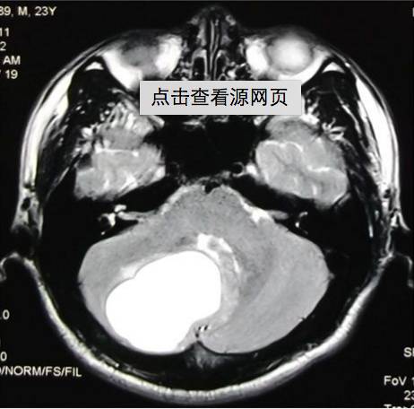 影像PPT - 18种脑囊肿或囊肿样占位的影像对比-29 影像PPT - 18种脑囊肿或囊肿样占位的影像对比-29