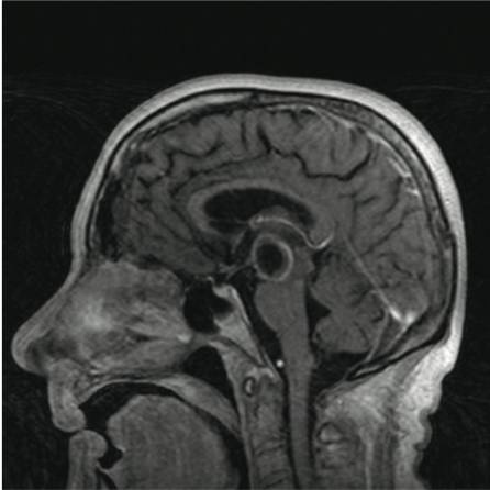 影像PPT - 18种脑囊肿或囊肿样占位的影像对比-1 影像PPT - 18种脑囊肿或囊肿样占位的影像对比-1