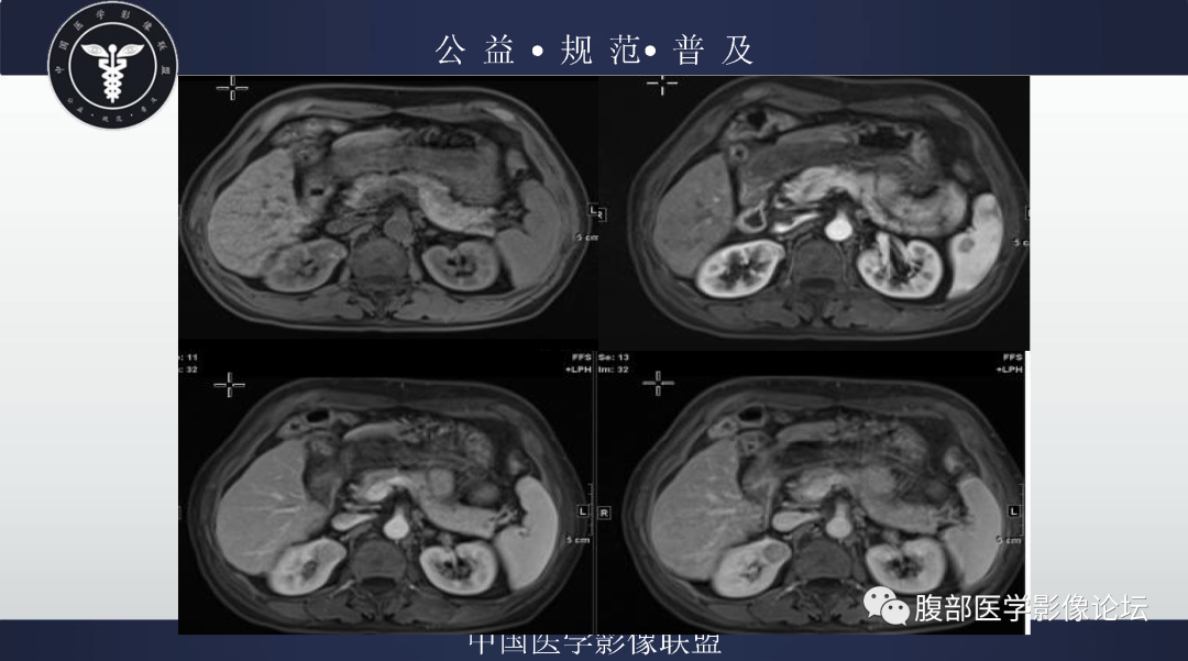 影像PPT - 【病例】肾脏嫌色细胞肾细胞癌1例MR影像-4
