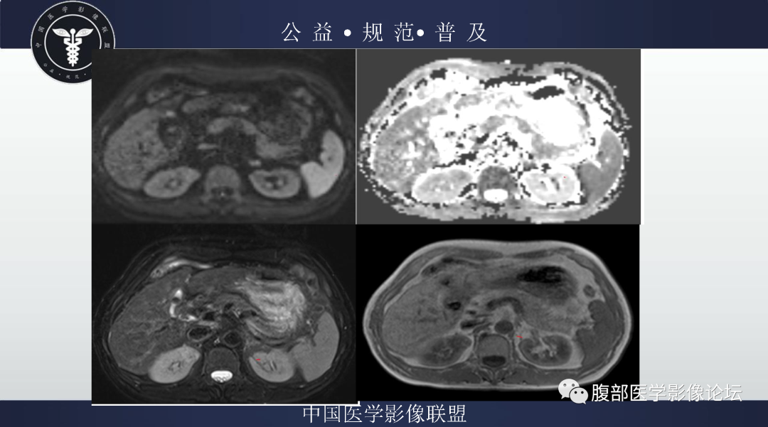 影像PPT - 【病例】肾脏嫌色细胞肾细胞癌1例MR影像-5