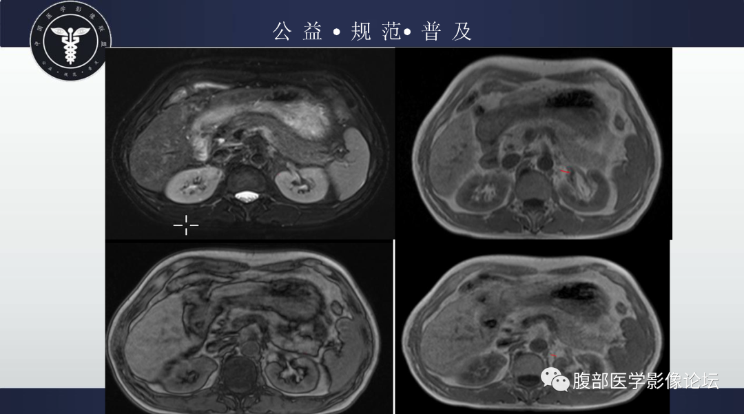 影像PPT - 【病例】肾脏嫌色细胞肾细胞癌1例MR影像-6