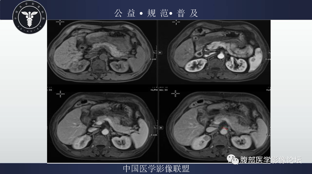 影像PPT - 【病例】肾脏嫌色细胞肾细胞癌1例MR影像-3
