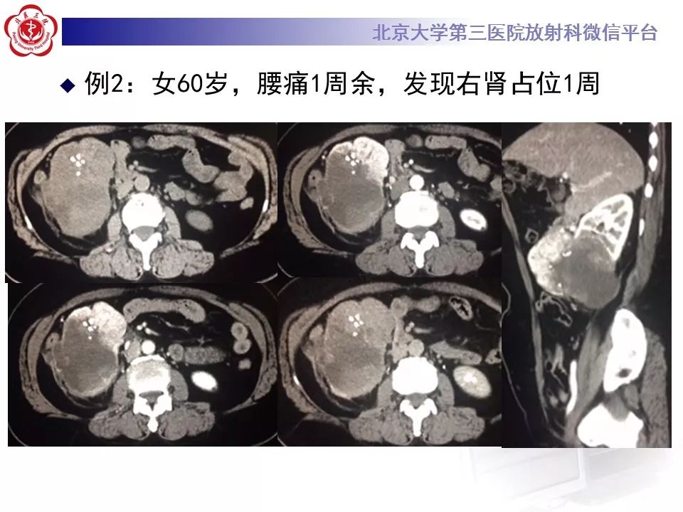 影像PPT - 【病例】肾脏嫌色细胞肾细胞癌1例MR影像-16