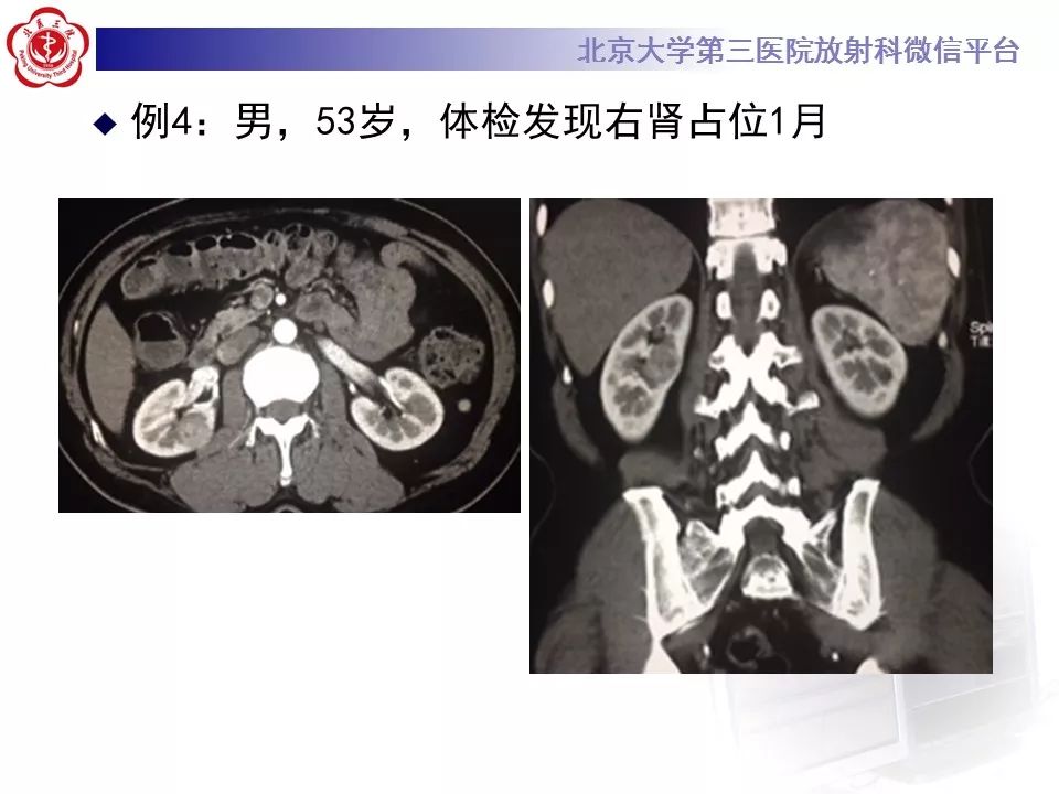 影像PPT - 【病例】肾脏嫌色细胞肾细胞癌1例MR影像-18