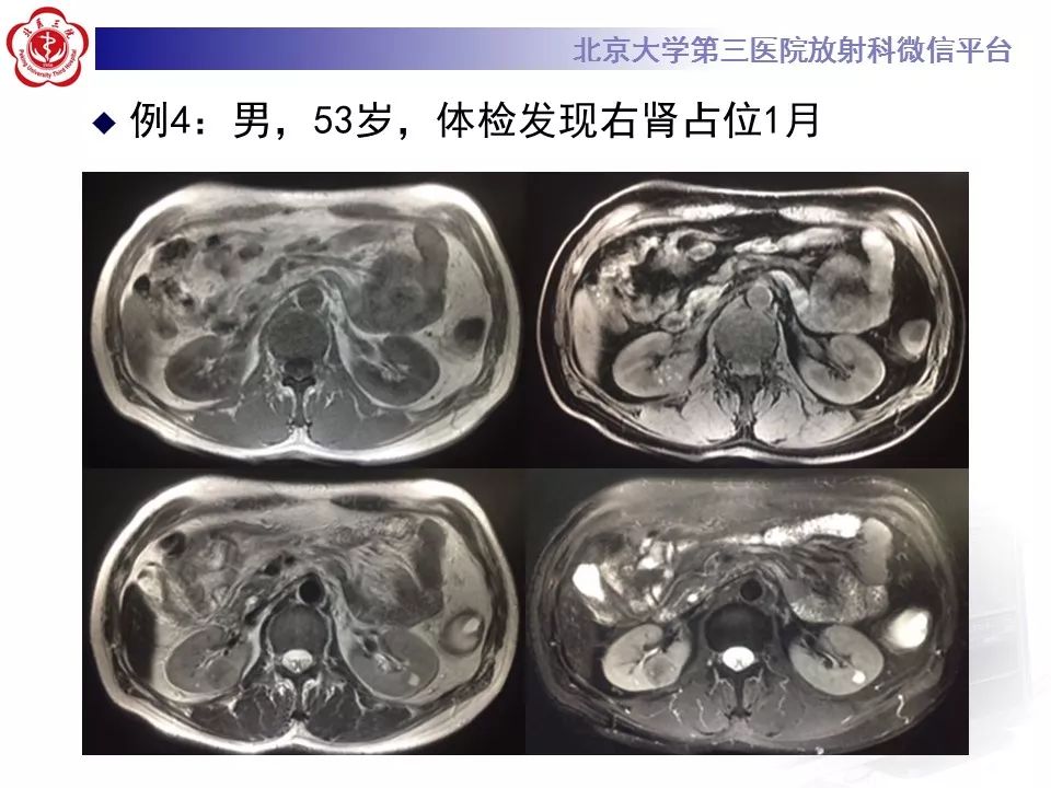影像PPT - 【病例】肾脏嫌色细胞肾细胞癌1例MR影像-19