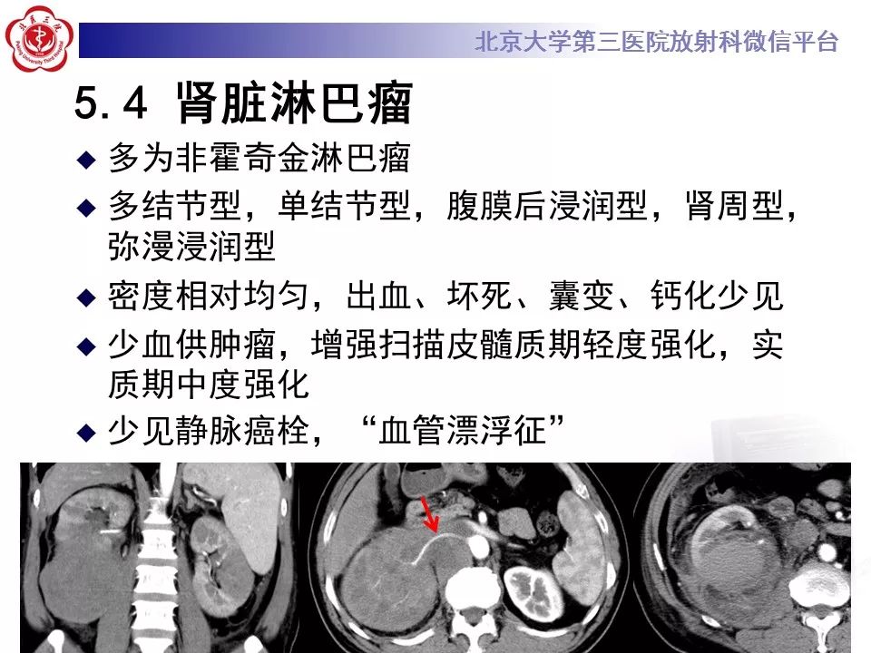 影像PPT - 【病例】肾脏嫌色细胞肾细胞癌1例MR影像-24