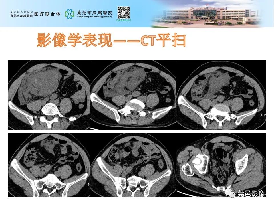 影像PPT - 【病例】输尿管癌并肾自发破裂一例CT-4