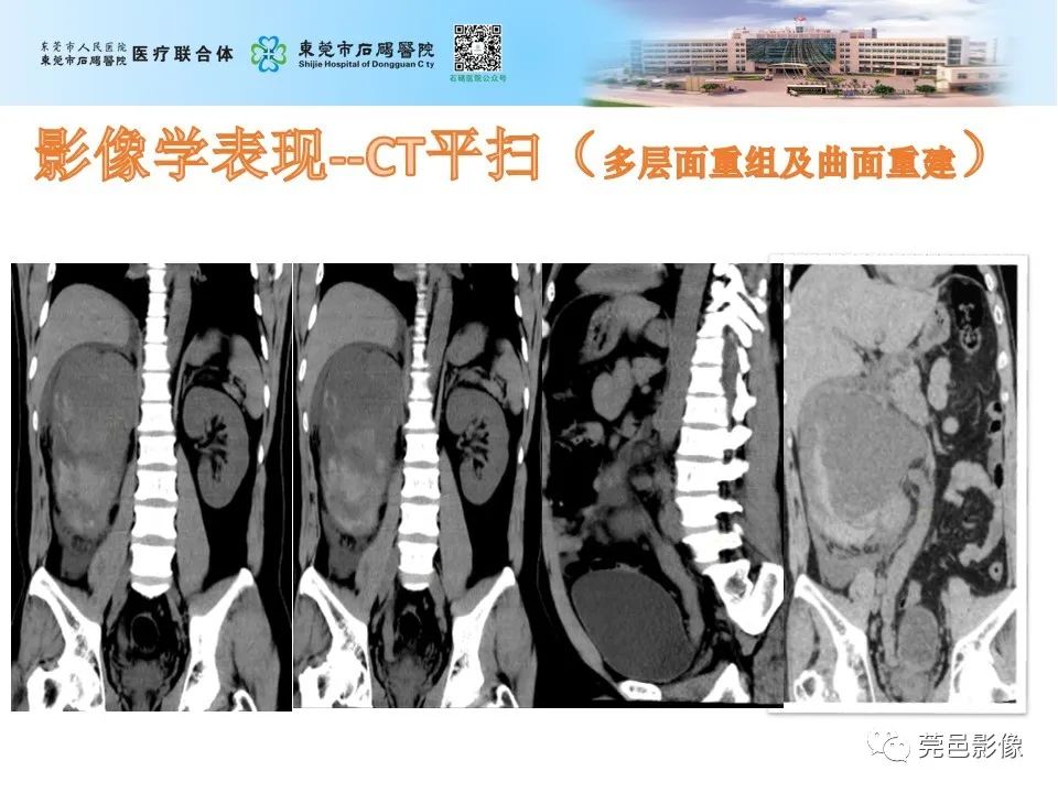 影像PPT - 【病例】输尿管癌并肾自发破裂一例CT-5
