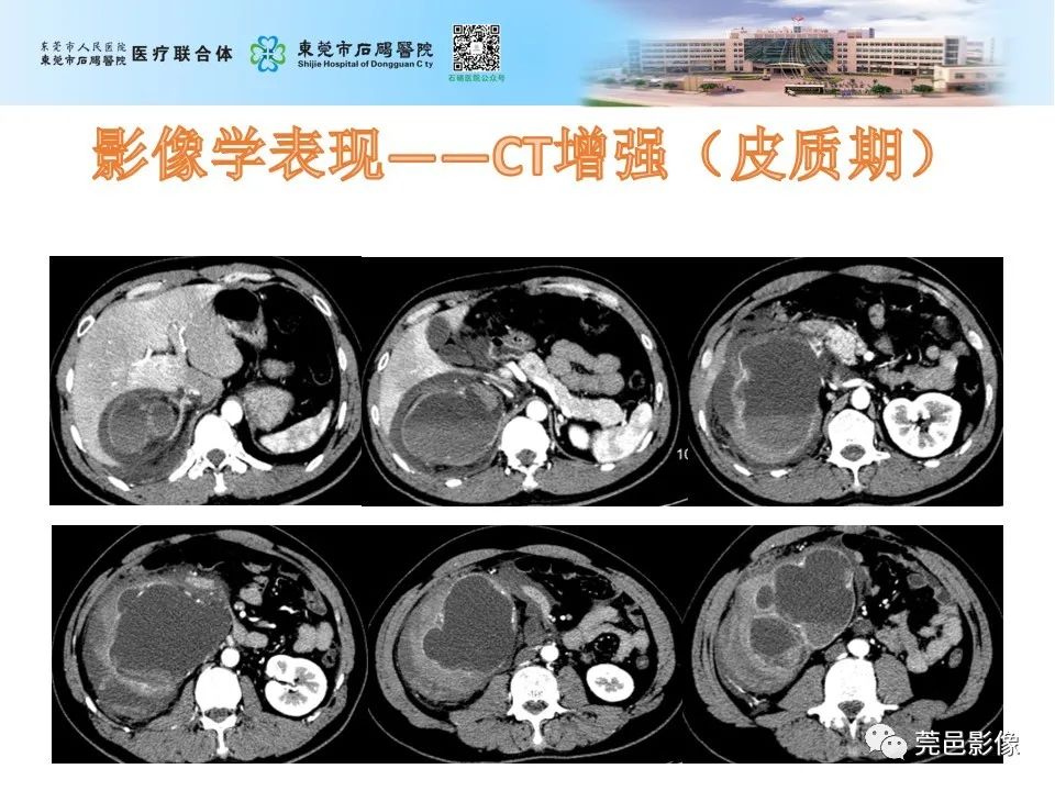 影像PPT - 【病例】输尿管癌并肾自发破裂一例CT-6