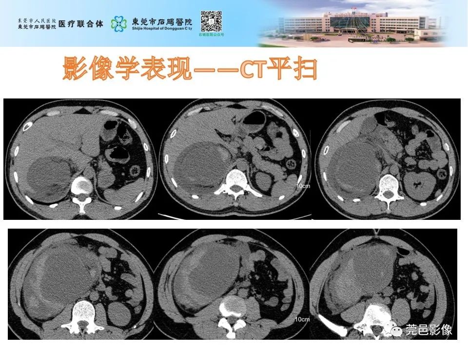 影像PPT - 【病例】输尿管癌并肾自发破裂一例CT-3