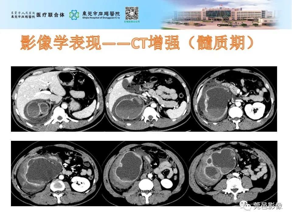 影像PPT - 【病例】输尿管癌并肾自发破裂一例CT-8