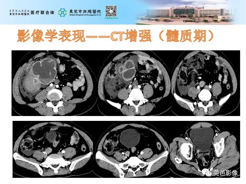 影像PPT - 【病例】输尿管癌并肾自发破裂一例CT-9