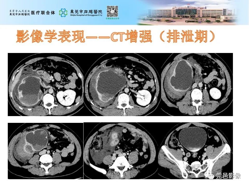 影像PPT - 【病例】输尿管癌并肾自发破裂一例CT-10