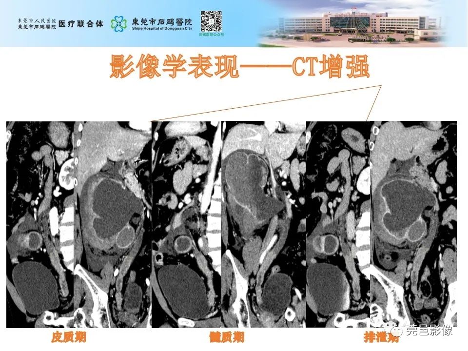 影像PPT - 【病例】输尿管癌并肾自发破裂一例CT-11