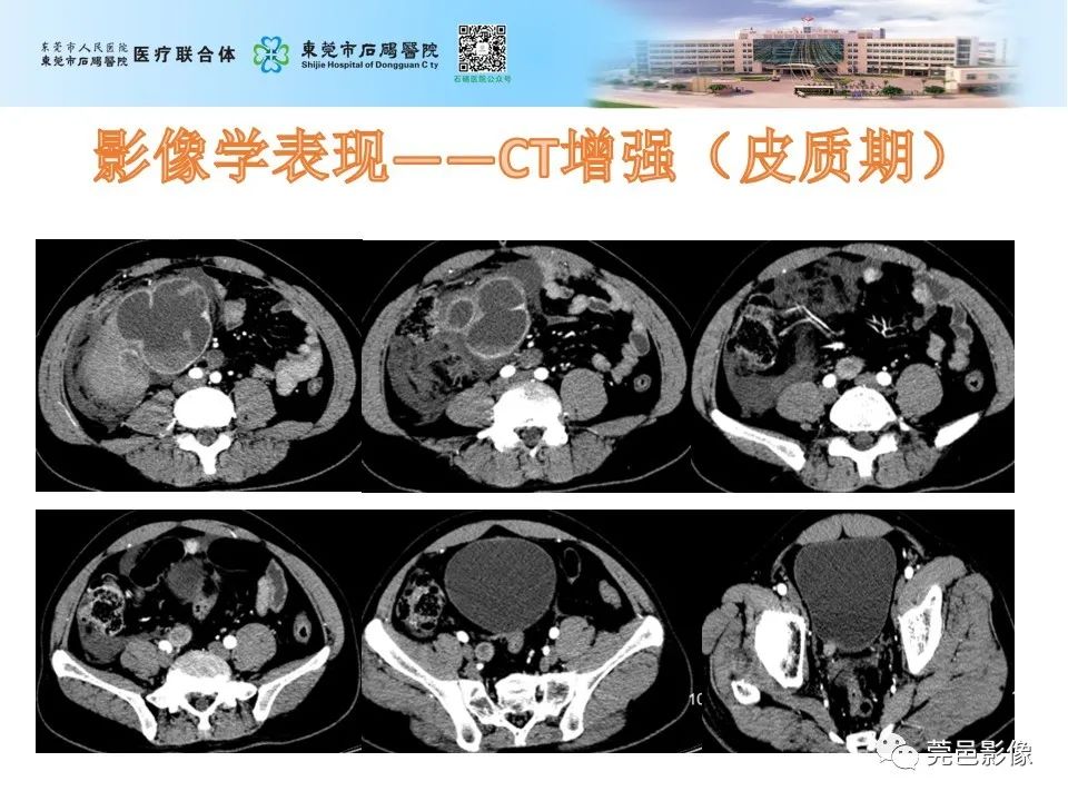 影像PPT - 【病例】输尿管癌并肾自发破裂一例CT-7