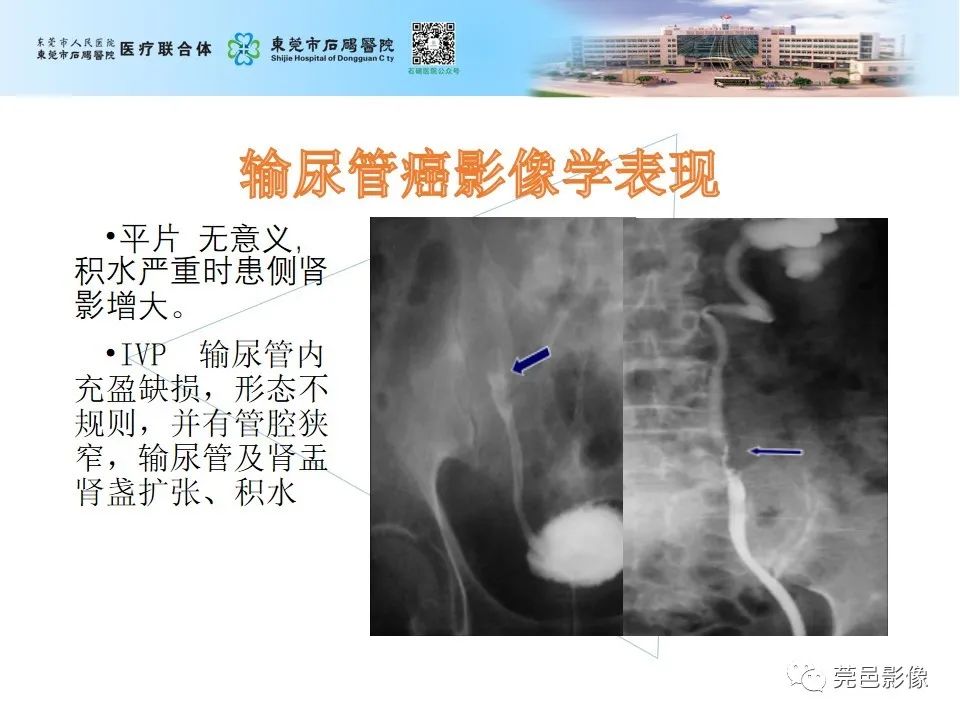 影像PPT - 【病例】输尿管癌并肾自发破裂一例CT-18