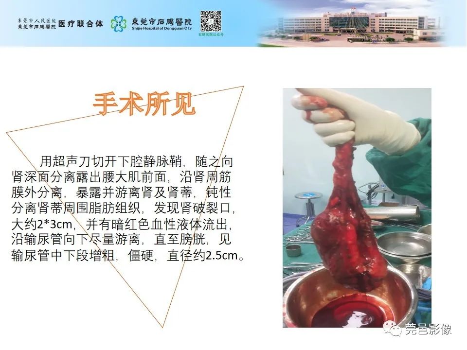 影像PPT - 【病例】输尿管癌并肾自发破裂一例CT-14