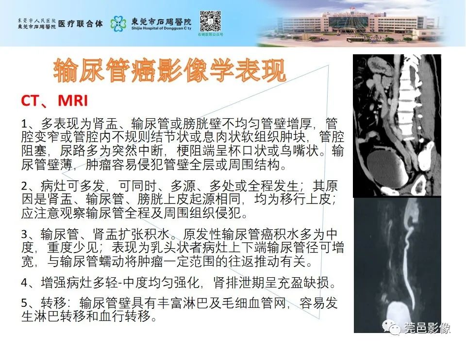 影像PPT - 【病例】输尿管癌并肾自发破裂一例CT-19