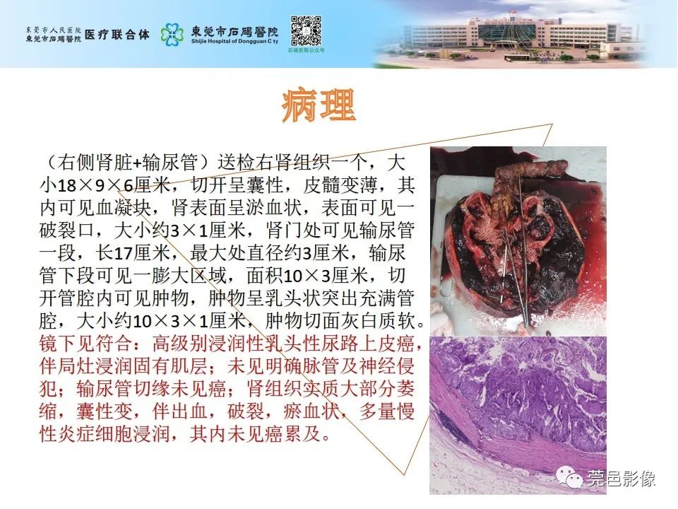 影像PPT - 【病例】输尿管癌并肾自发破裂一例CT-15