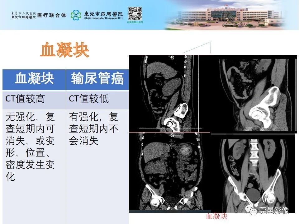 影像PPT - 【病例】输尿管癌并肾自发破裂一例CT-22
