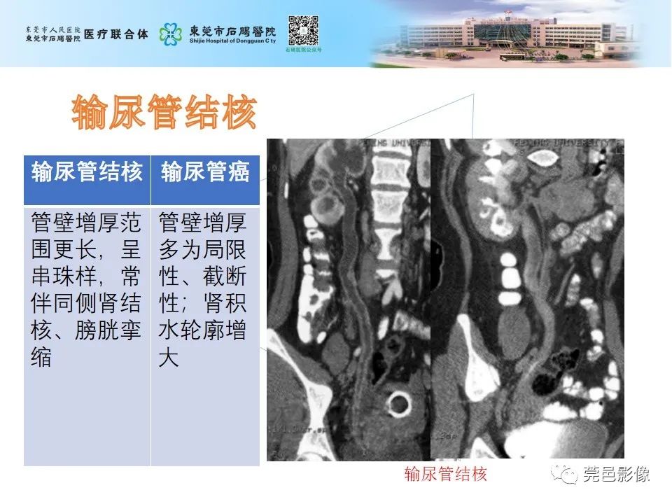 影像PPT - 【病例】输尿管癌并肾自发破裂一例CT-24