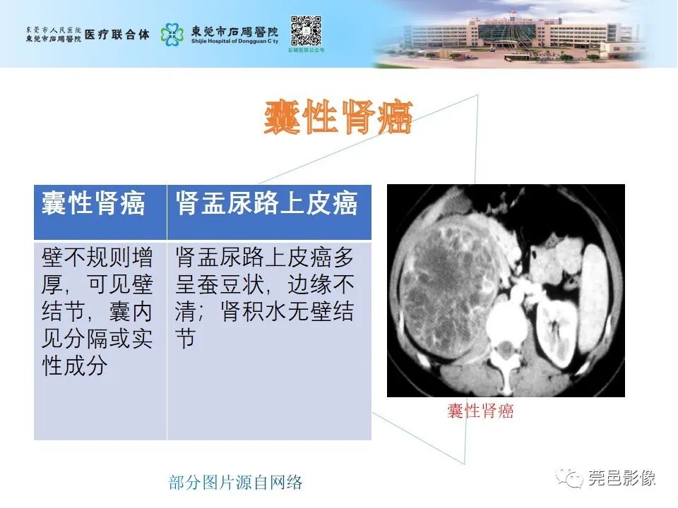 影像PPT - 【病例】输尿管癌并肾自发破裂一例CT-25