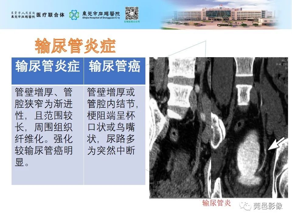 影像PPT - 【病例】输尿管癌并肾自发破裂一例CT-23