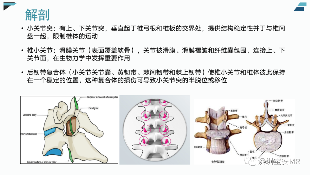 影像PPT - 【PPT】椎小关节常见病变的影像表现-4