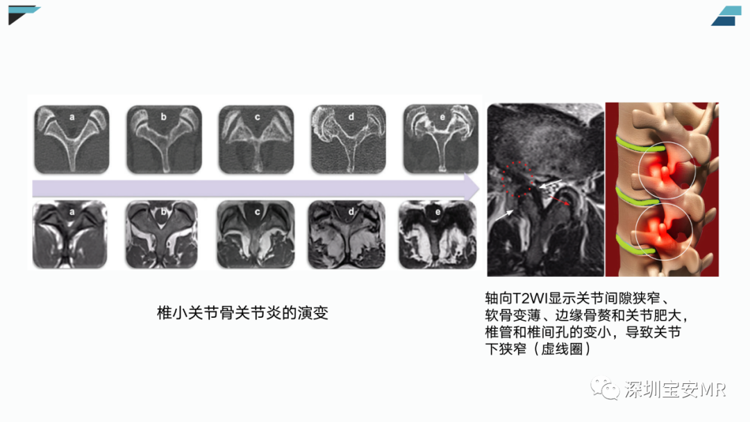 影像PPT - 【PPT】椎小关节常见病变的影像表现-9