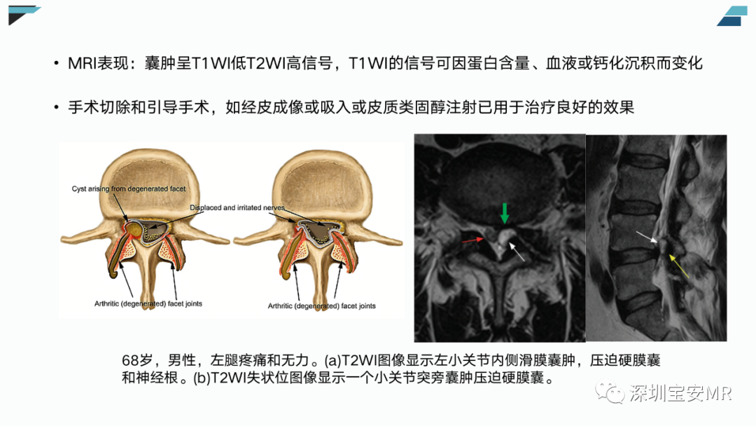 影像PPT - 【PPT】椎小关节常见病变的影像表现-12