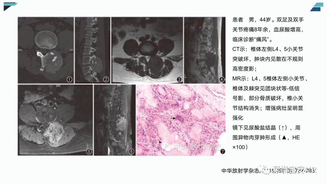 影像PPT - 【PPT】椎小关节常见病变的影像表现-23