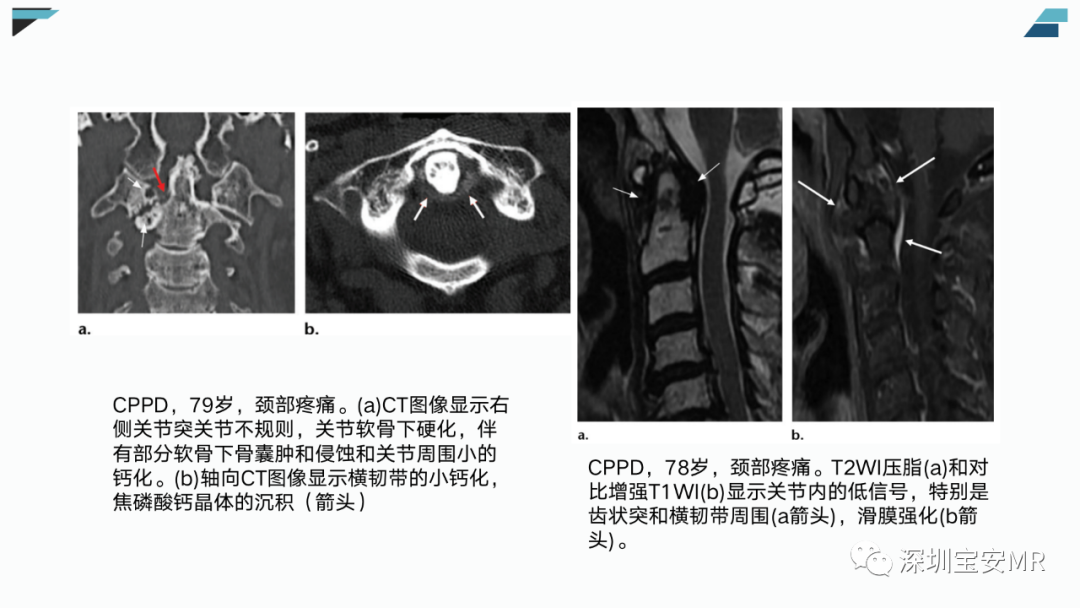 影像PPT - 【PPT】椎小关节常见病变的影像表现-25