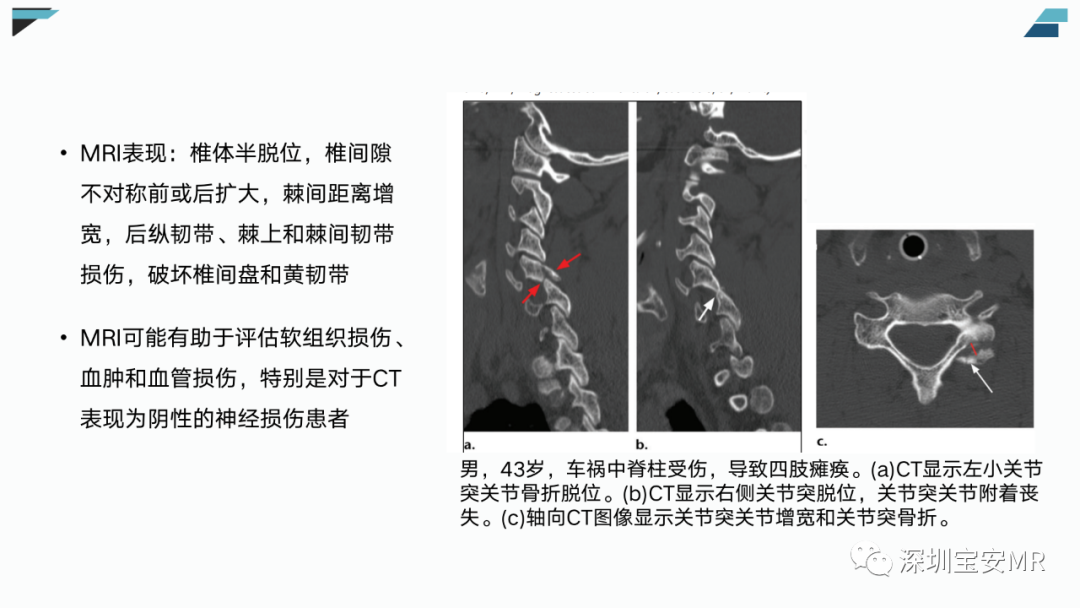 影像PPT - 【PPT】椎小关节常见病变的影像表现-27