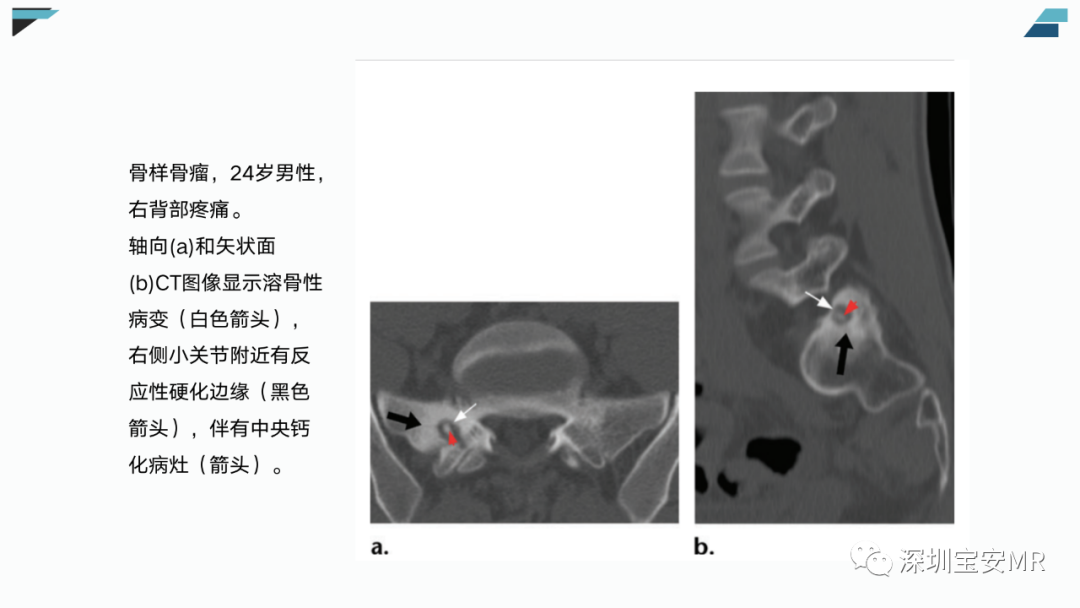 影像PPT - 【PPT】椎小关节常见病变的影像表现-30