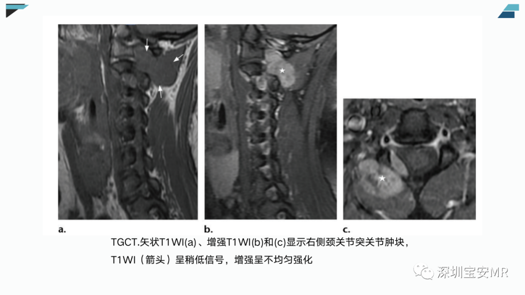 影像PPT - 【PPT】椎小关节常见病变的影像表现-36