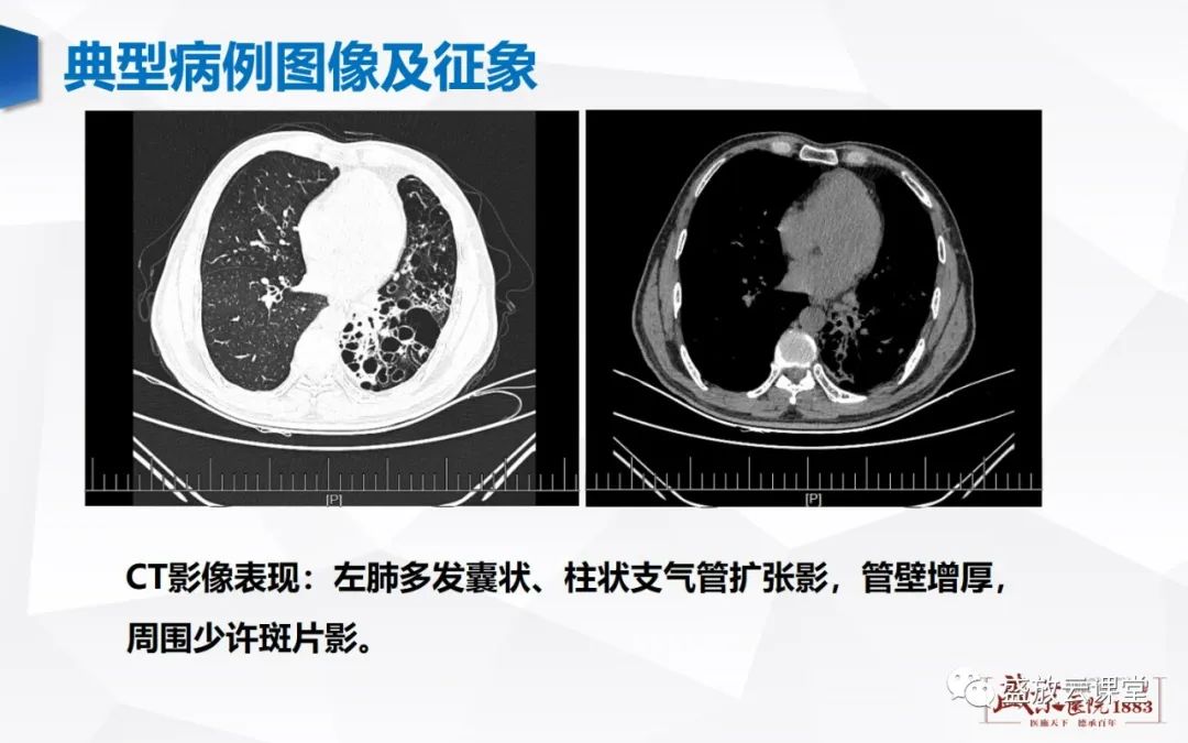 影像PPT - 【PPT】支气管病变-4