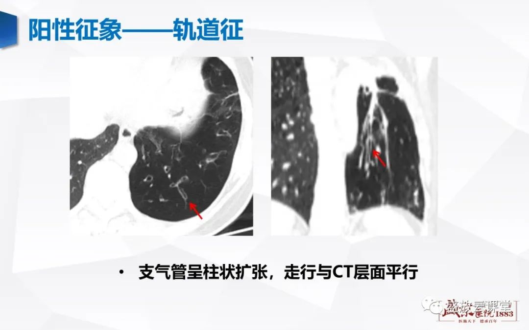 影像PPT - 【PPT】支气管病变-11