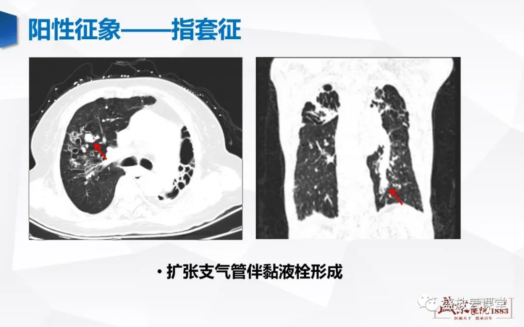 影像PPT - 【PPT】支气管病变-12