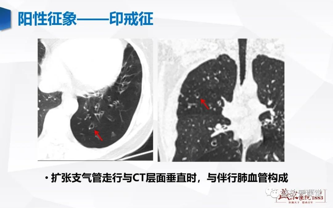 影像PPT - 【PPT】支气管病变-10