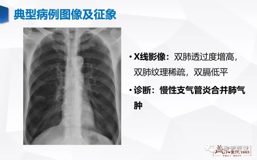 影像PPT - 【PPT】支气管病变-18