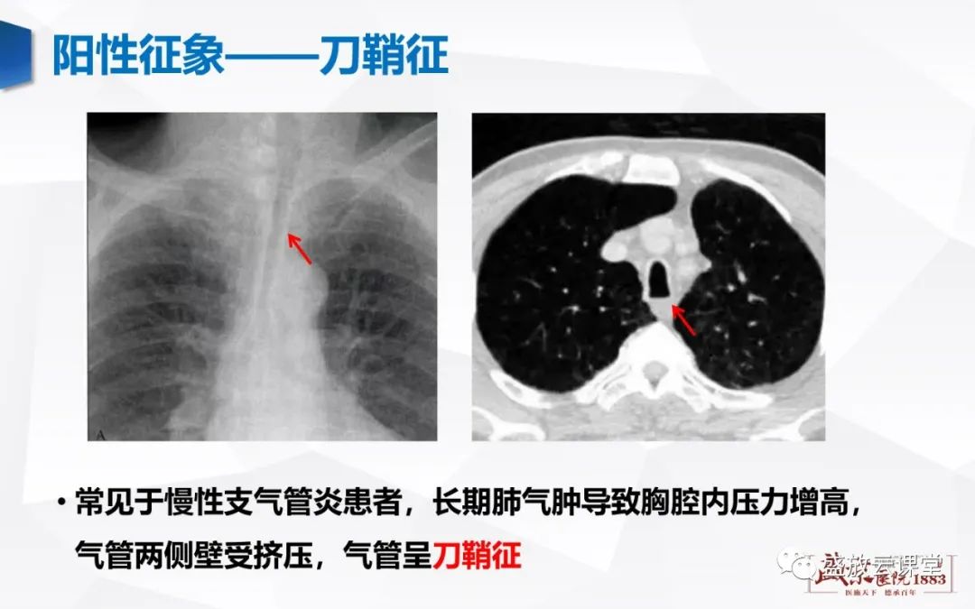 影像PPT - 【PPT】支气管病变-19